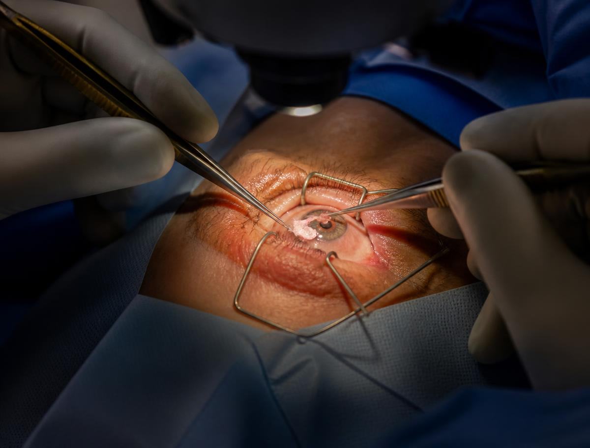 Microcirurgia ocular: remoção do tecido do pterígio sob microscópio cirúrgico